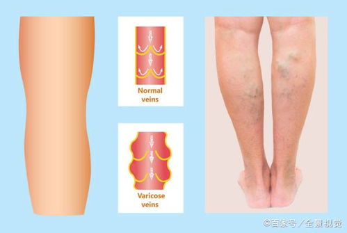 血不通,气则不顺 血管堵塞时,多有这4个症状,占一个也要检查 身体